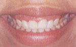 Deficiency of Vitamin C